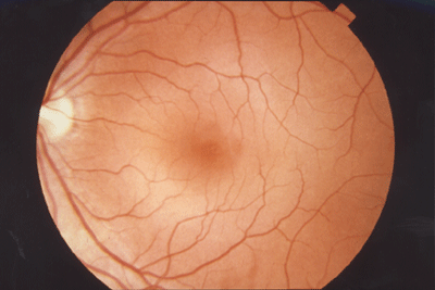 Normal Fundus