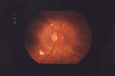 Proliferative Diabetic Retinopathy Proliferative Diabetic Retinopathy