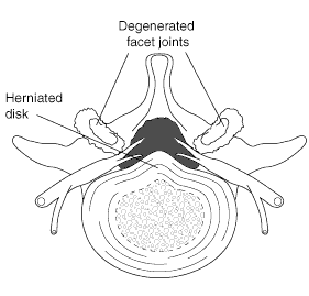 Spinal stenosis caused by herniated disks and spondylolisthesis